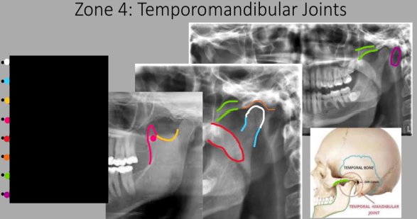 <p>What do we see in Zone 4?</p>