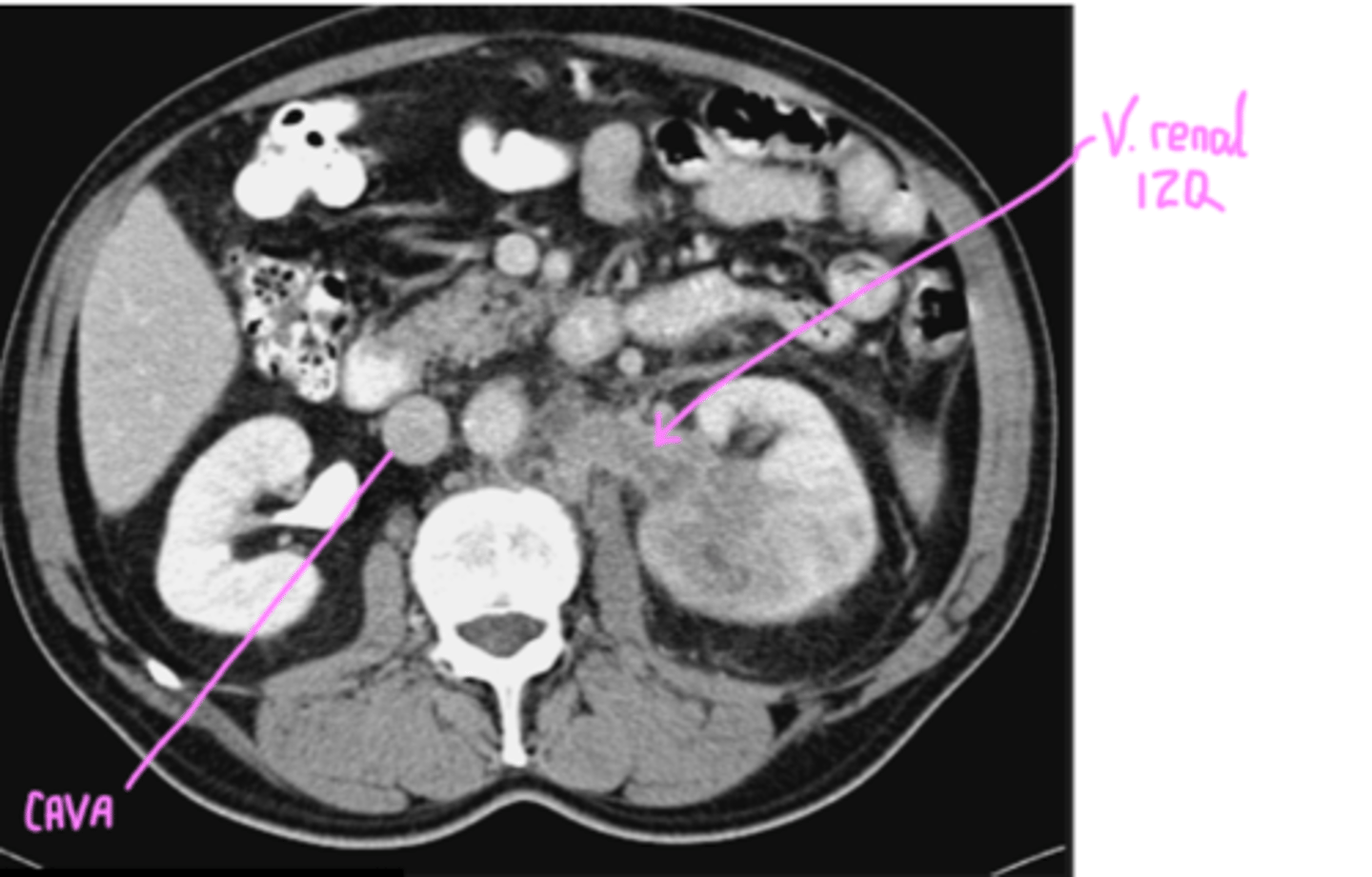 <p>Puede causar trombosis tumoral.</p><p>vena renal está completamente infiltrada: tiene color tumor, no se ve el lumen.(debería verse blanca)</p>