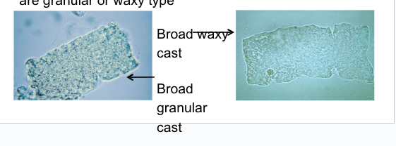 <ul><li><p>aka RENAL FAILURE CAST</p></li><li><p>2-6x wider than regular casts</p></li><li><p>can be any type but granular and waxy most common</p></li></ul><p></p>