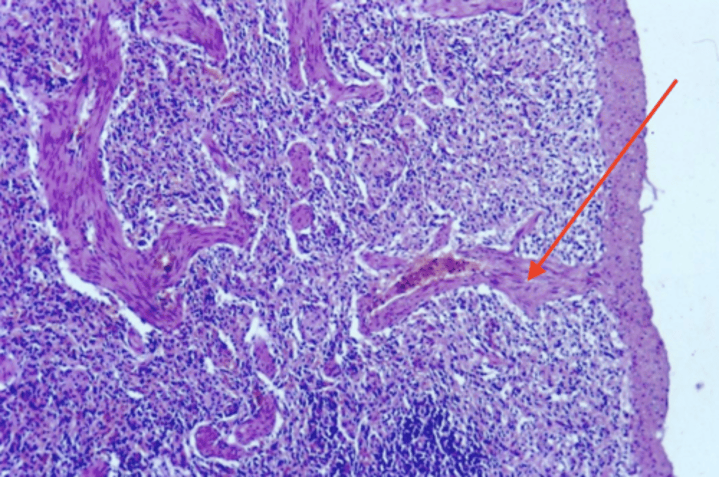 <p>what part of the stroma is this CT?</p>
