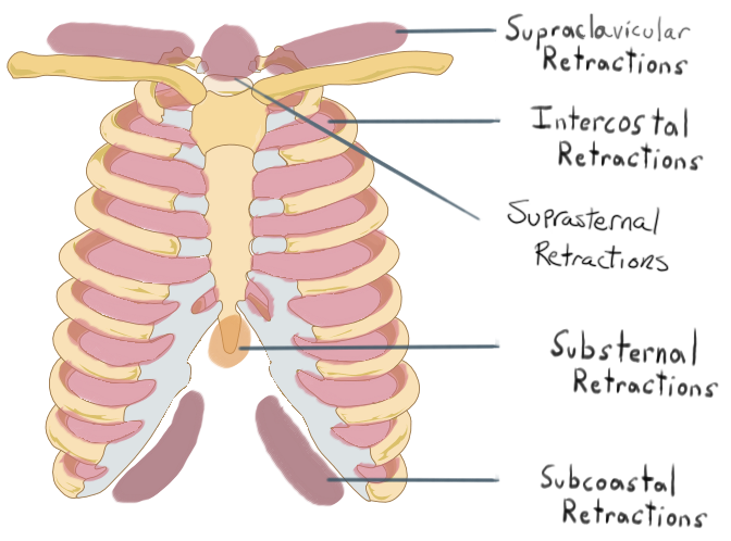 <ul><li><p>sinking in of soft tissues relative to the cartilaginous and bony thorax</p></li><li><p>types: </p><ul><li><p>supraclavicular retractions</p></li><li><p>suprasternal notch retractions</p></li><li><p>intercostal retractions</p></li><li><p>substernal retractions</p></li><li><p>Subcostal retraction</p></li></ul></li></ul>