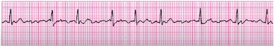 <p>if sustained with rapid ventricular response: control ventilation rate and return to sinus, pacer</p><p>Ca Channel Blocker (<strong>Cardizem</strong>), Digoxin, amiodarone, BBs</p><p><strong>cardioversion </strong>(if meds not working/pt is unstable)<br><strong>Coumadin </strong>(anti coag)</p>