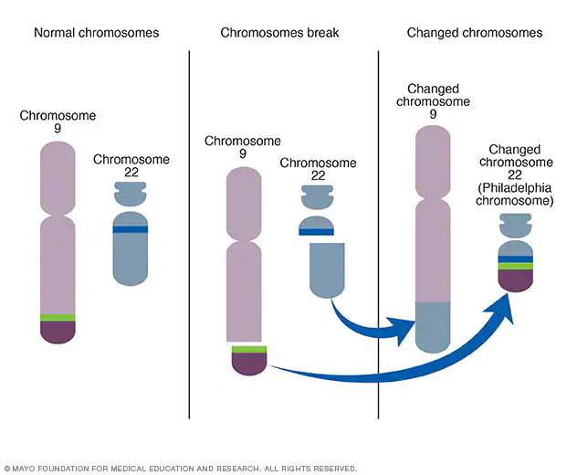 <p>Хронична миелоидна леукемија (Chronic myelogenous leukemia)</p><ul><li><p>Оваа болест се јавува кога се случува реципрочна транслокација при митоза на клетките кои се прекурсори на белите крвни зрнца. Размената на голем дел од хромозомот 22 со мал фрагмент од врвот на хромозомот 9 произведува многу скратен, лесно препознатлив хромозом 22, наречен<strong> хромозом Филаделфија</strong></p></li></ul>