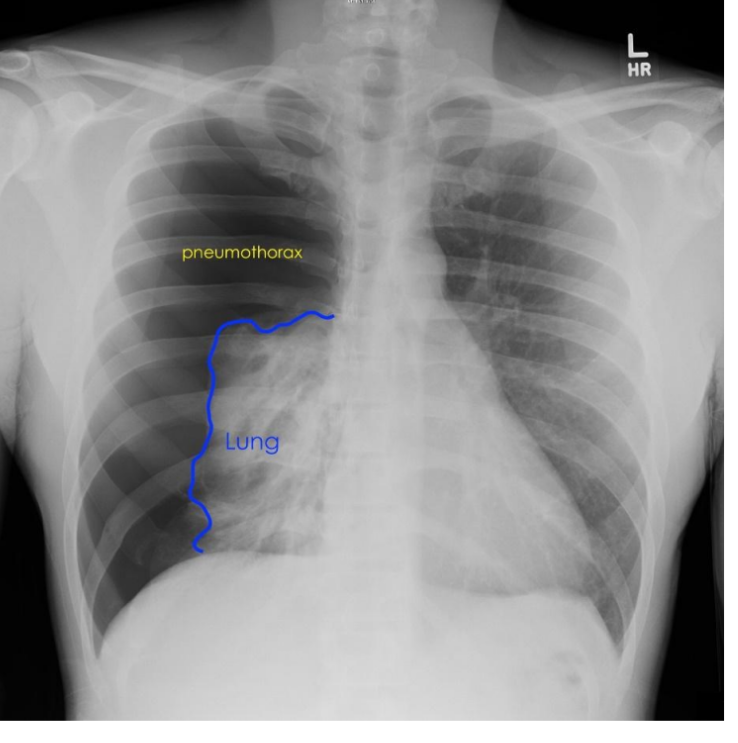 <ul><li><p>Pneumothorax is a collapsed lung.</p></li><li><p>Cause: When atmospheric air invades the pleural cavity</p></li><li><p>Treatment: Needle aspiration, or chest tube insertion to remove air in the pleural space.</p></li></ul><p></p>