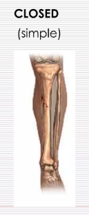 <p>closed (simple) </p>