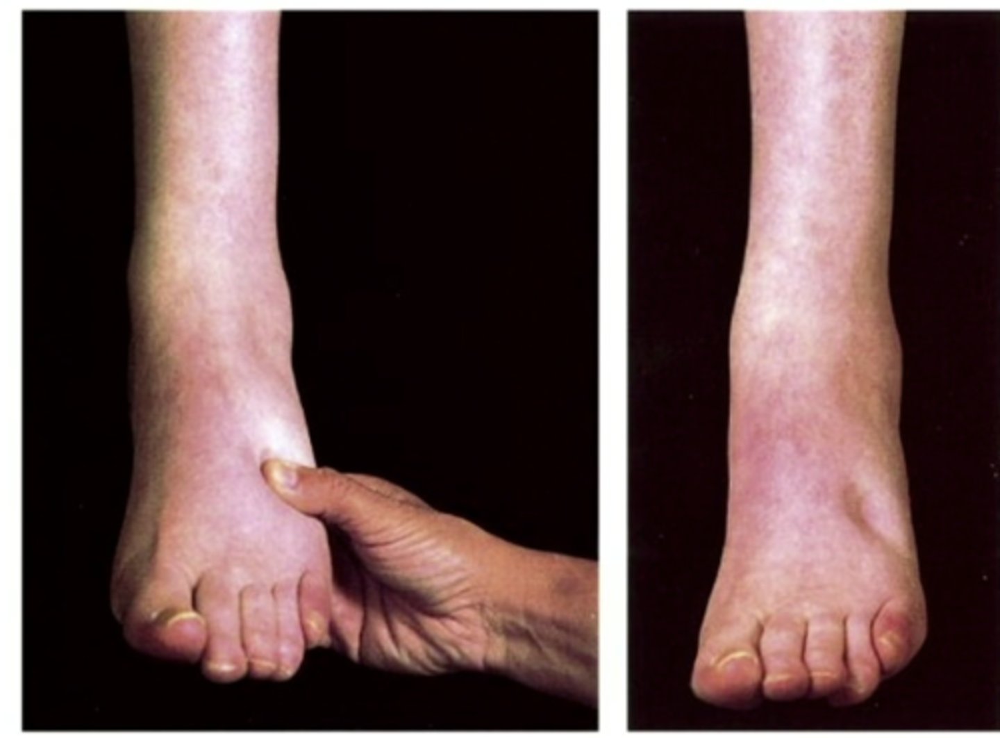 <p>palpable swelling produced by an increase in interstitial fluid volume</p><p>does not become evident until the interstitial volume has been increased by 2.5-3.0 L</p><p>can be localized, systemic, or dependent</p><p>generally accounts for 10-30% of body weight, wounds heal more slowly, risks of pressure sores and infections increase, may interfere with movement, can be life threatening</p>