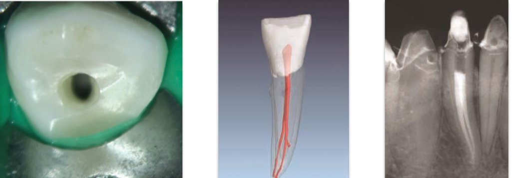 <p>2 roots and canals&nbsp;</p>