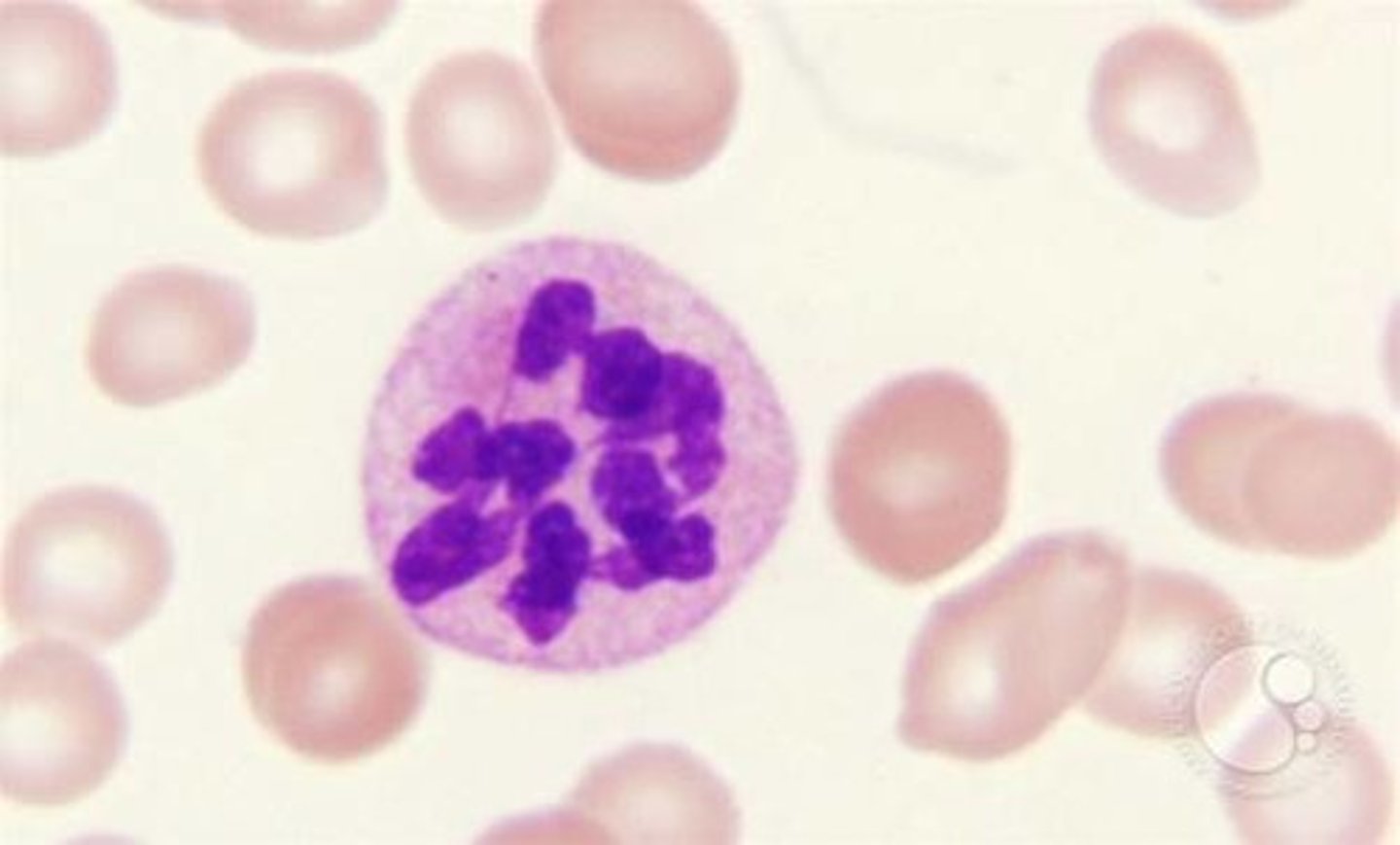 <p>T/F: This neutrophil has a hyper segmented nucleus. This may indicate a B12 or folic acid deficiency.</p>