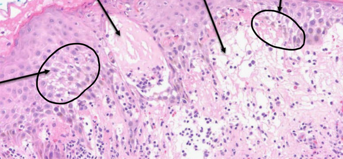 <p>what condition is depicted</p>