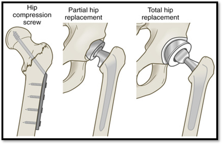 <p><span>•Often due to osteoporosis</span></p><p><span>•</span><strong><u><span>Signs/Symptoms: </span></u></strong><span>external rotation, muscle spasm, shortening of extremity, severe pain, tenderness</span></p><p><span>•</span><strong><u><span>Complications: </span></u></strong><span>disruption of blood supply to femoral head= necrosis&nbsp;&nbsp;&nbsp;&nbsp;&nbsp;&nbsp;&nbsp;&nbsp;&nbsp; </span></p><p><strong><u><span>Diagnostic:</span></u></strong><span> CT scan, Xray</span></p><p><span>•</span><strong><u><span>Treatment: </span></u></strong><span>Buck’s traction, internal fixation, femur replacement, total hip replacement. </span></p><p><strong><u><span>Meds: </span></u></strong><span>analgesics, muscle relaxants.</span></p><p><span>•</span><strong><u><span>Nursing care: </span></u></strong><span>use of trapeze bar &amp; opposite side rail, pillow between knees, prevent dislocation, avoid hyperextension, use of anticoagulant</span></p><p><strong><u><span>If prosthesis dislocation occurs= KEEP PATIENT NPO!</span></u></strong></p>