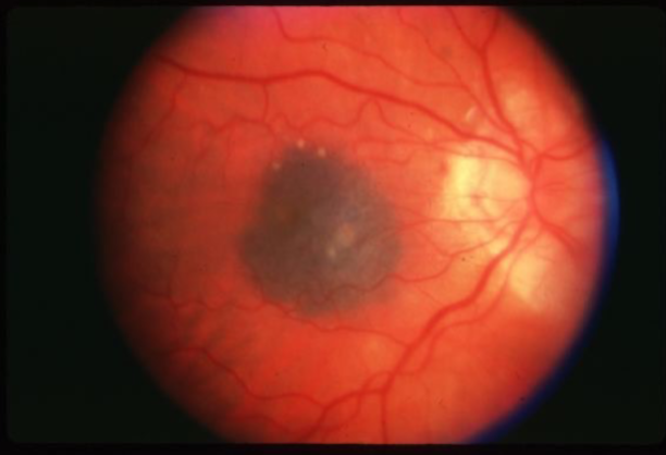 <p>what is the concern for this being melanoma? </p>