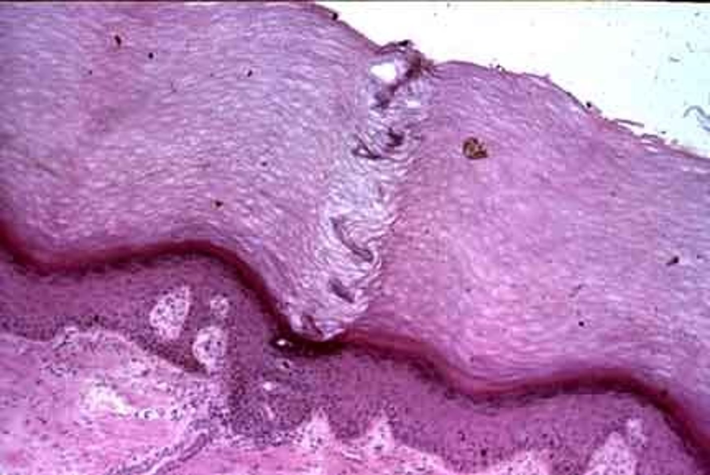 <p>Stratified Squamous epithelium with keratin</p>