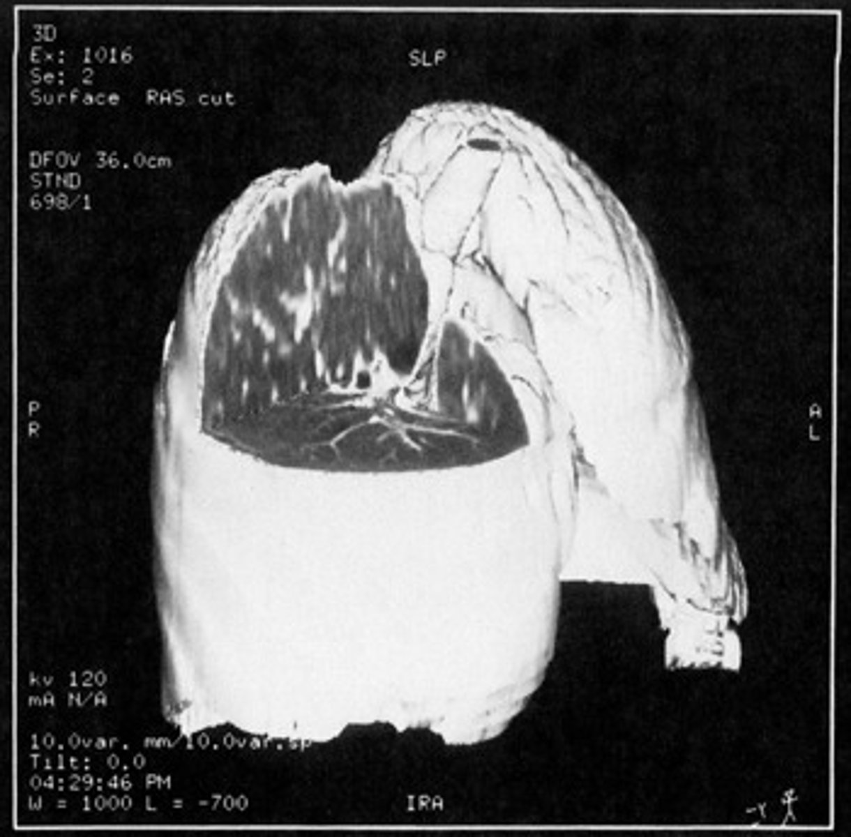 <p>The technique that provides the detail of the outer portions of the 3D model while maintaining the typical CT detail of the lungs inside is called:</p>