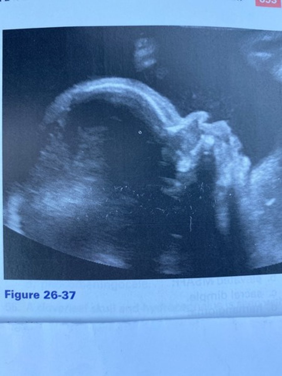 <p>The fetus in Figure 26-37 is suffering from achondroplasia. What is noted in this profile image?</p><p>a. Ventriculomegaly</p><p>b. Frontal bossing</p><p>c. Lemon sign</p><p>d. Cebocephaly</p>