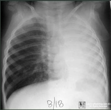 <p>What pathology is seen on this x-ray?</p>
