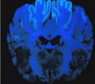 <ul><li><p><strong>MOA: </strong><u>Thiamine deficiency</u></p><ul><li><p><strong>young ruminants </strong>on <strong>high grain diet</strong>- <strong>2-8m </strong>old</p></li><li><p><strong>ruminal acidosis</strong></p></li><li><p>brakenfern, sulfur </p></li></ul></li><li><p><strong>CS:</strong> Cerebrocortical edema, stargazing, <strong>Cortical blindness w/ ok PLR, Odontopresis</strong></p></li><li><p><strong>ID: Response to thiamine, </strong>CSF, <strong>woods lamp</strong></p><ul><li><p><strong>DDX: </strong>preg tox, salt/lead toxic, TEME, rabies, listeria</p></li></ul></li><li><p><strong>TX: </strong>thiamine, dex, feed improve</p></li></ul><p></p>