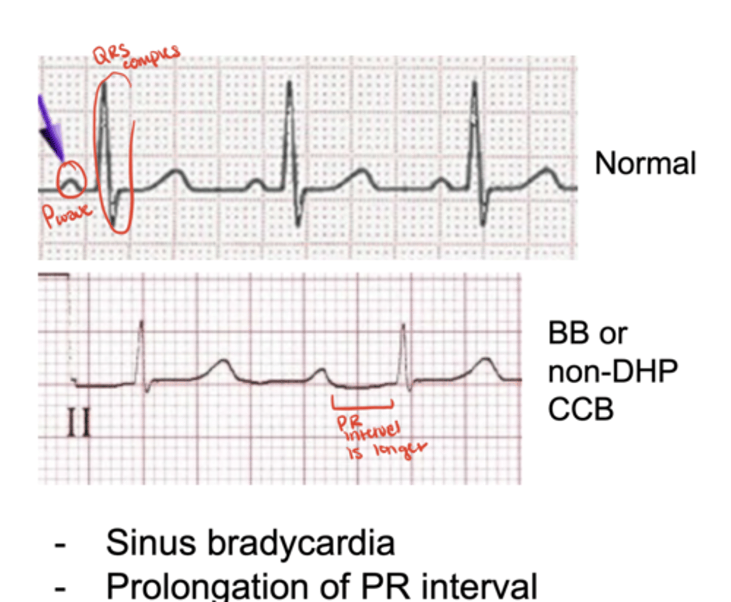 <p>prolong PR interval due to AV nodal delay</p>