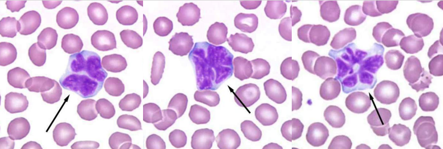 <p>A. Identify the abnormality / cell</p><p>B. This is seen in what condition / disease</p>