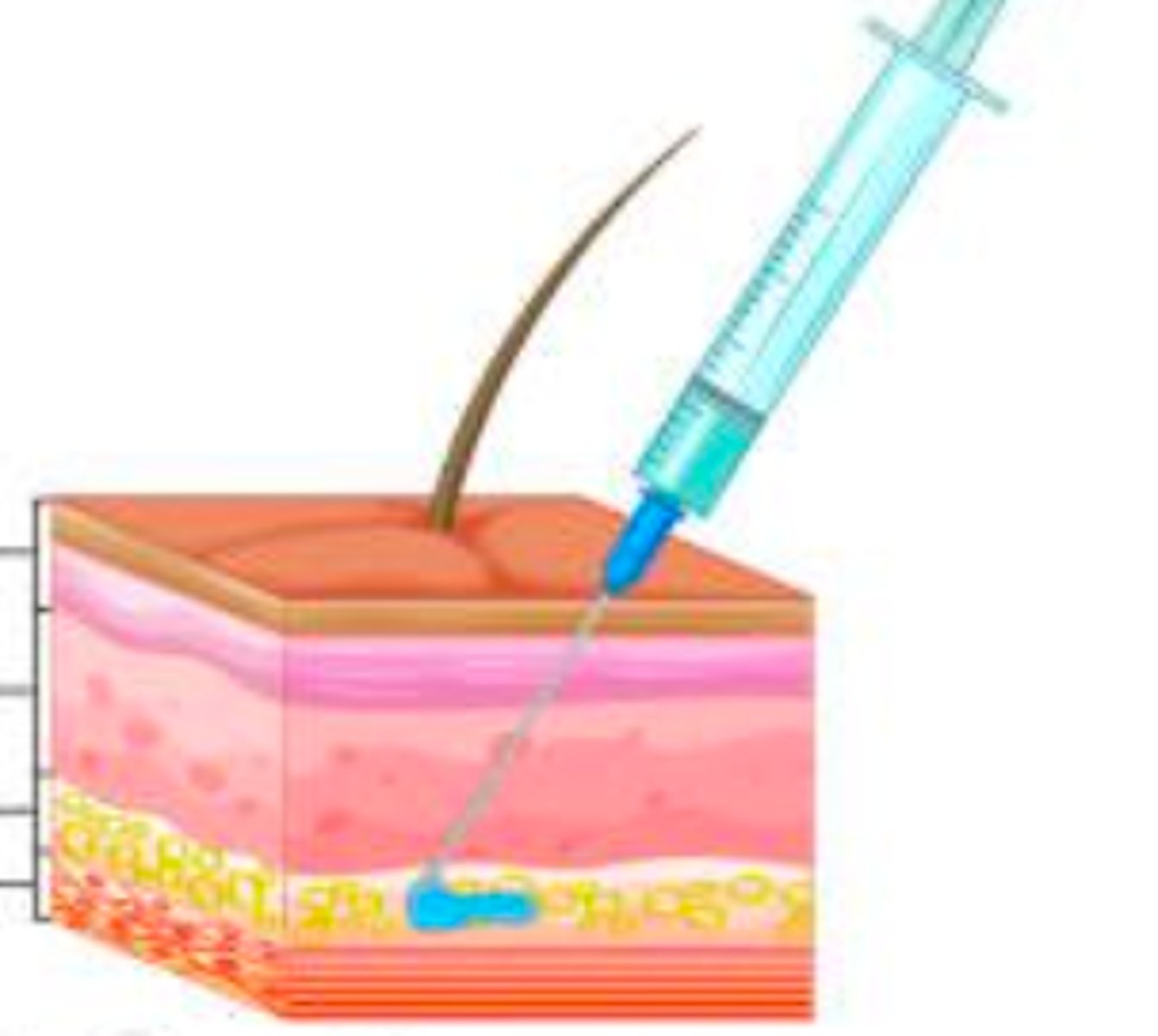 <p>- drug injected under skin into subcutaneous tissue​</p><p>- slow and constant absorption - below the first couple layers of skin</p><p>- Sites include anterior thigh, upper back, outer upper arms, and abdomen​</p><p>- Example - insulin injection</p>