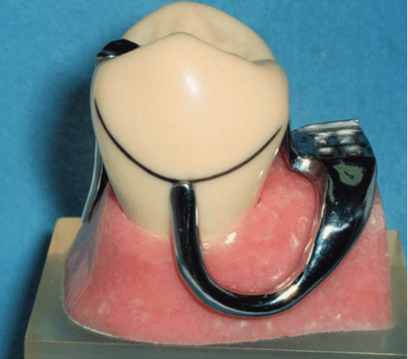 <p>clasp </p><p>• Retentive tip in gingival 1/3 of tooth</p><p>• More esthetic</p><p>• Less contact (Hygiene)</p><p>• Cast infrabulge clasps: Stress releasing design compensates for the difference in movement between teeth and mucosa – good for adjacent to distal extension areas, if an abutment is periodontally involved, if extensive edentulous space is present</p><p>---RPI clasp assembly (MESIAL rest, proximal plate, I bar)</p><p>---Other options: T bar, half T bar, etc</p>