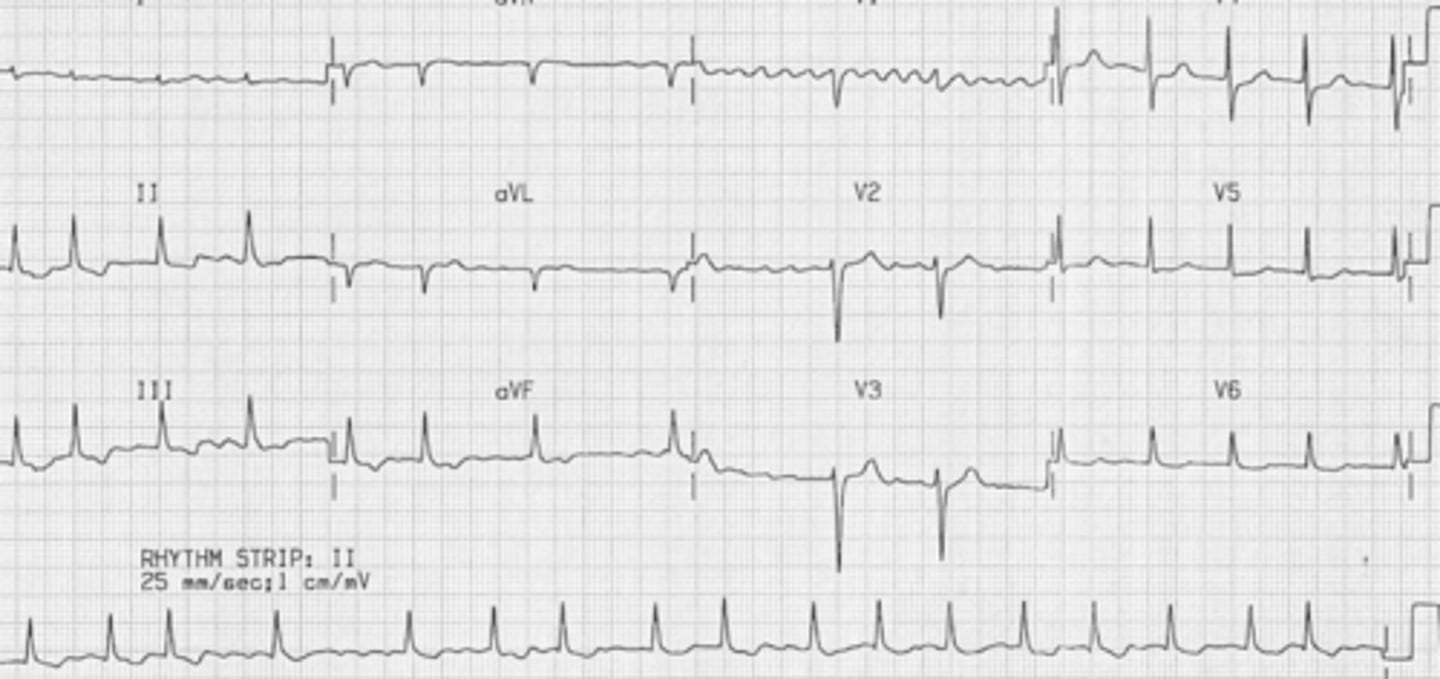 <p>What is the rhythm</p>