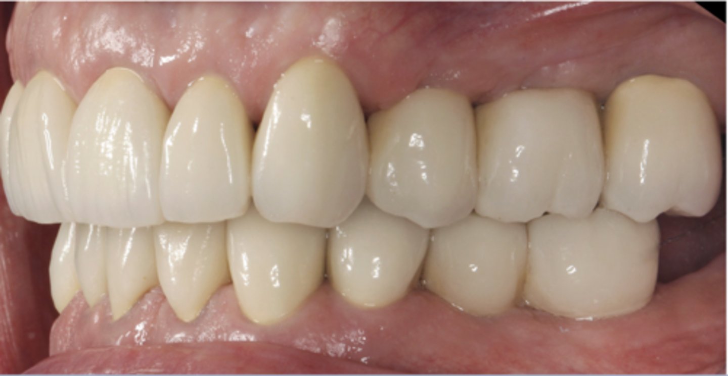 <p>Define the following:<br>•The complete intercuspation of the opposing teeth independent of condylar position<br>•Best fit of the teeth regardless of the condylar position</p>