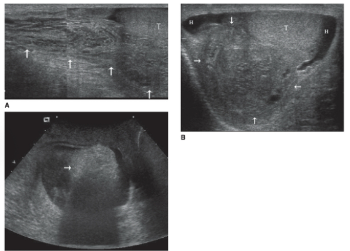 <p><span>What is it called when bowel protrudes through inguinal canal into tunica vaginalis of scrotum (Peristalsis will be present and confirms diagnosis)?</span></p>