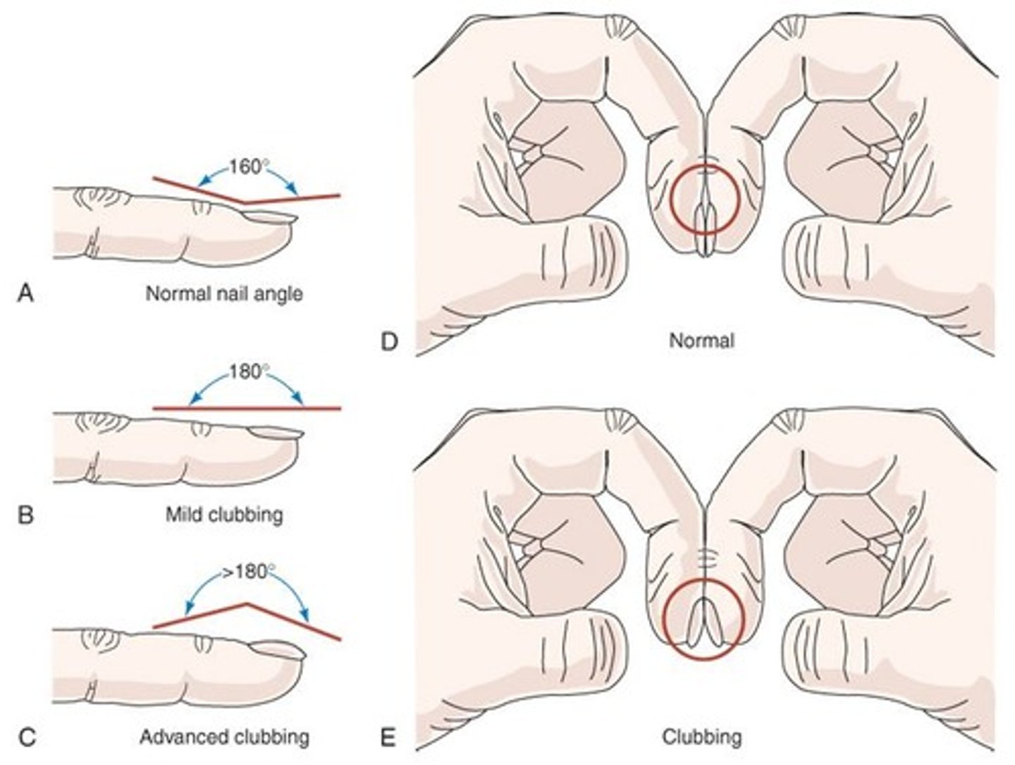 <p>Progressive exertional dyspnea, thin appearance, use of accessory muscles, pursed-lip breathing, minimal or absent cough, digital clubbing, and barrel chest.</p>