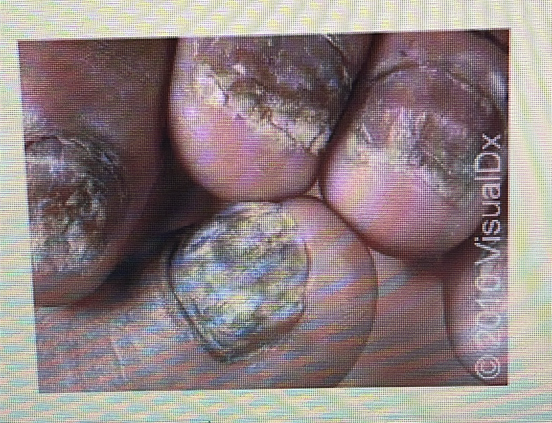 <p>NAIL DISORDER</p><p><span style="font-family: Calibri, sans-serif"><strong>Onychomycosis</strong>: Nail fungus in your fingernails or toenails.</span></p>