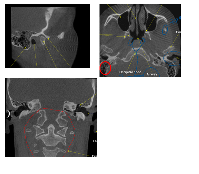<p>ID external auditory meatus </p>