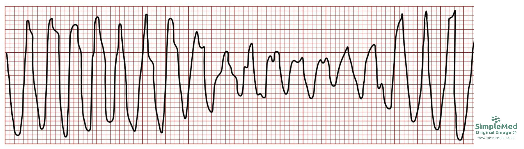 <p>name ECG pattern</p>