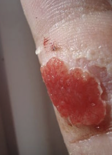 <p>excessive granulation tissue protruding above the level of the surrounding skin that blocks re-epithelization</p>