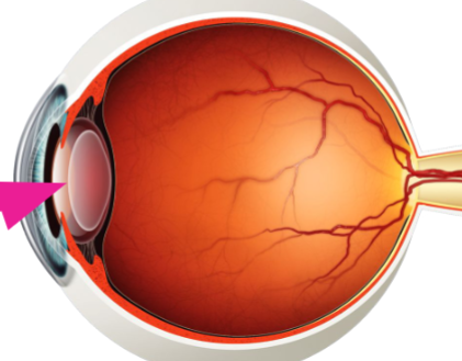 <p>fluid between the cornea and iris</p>