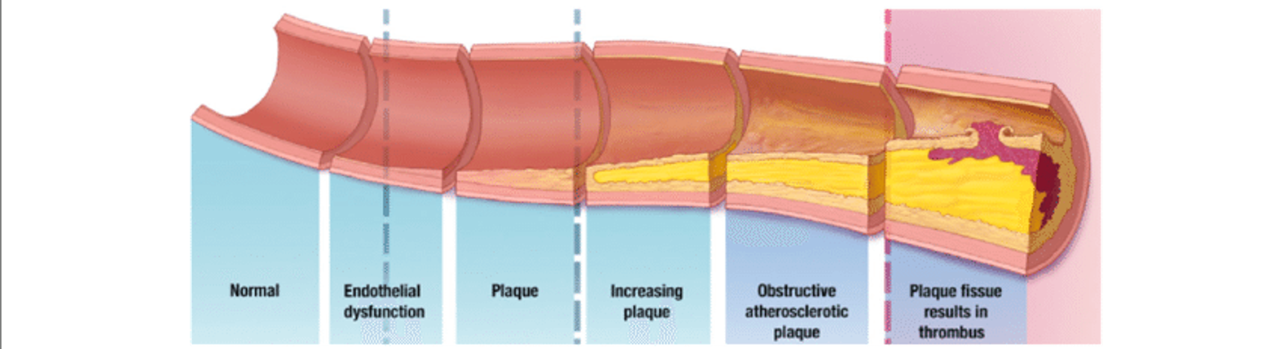 <ul><li><p>Thrombosis is the formation of the clot, the thrombus is the clot and the embolism is the clot on the move</p></li><li><p>Can be slowed or reversed&nbsp;</p></li><li><p>&gt;75% = symptoms&nbsp;</p></li></ul><p></p>