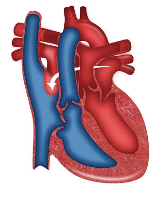 __**● Defect:**__  

○ The aorta and the pulmonary artery are switched 

○ Two parallel circuits  

■ Oxygenated blood continuously circulating through  the pulmonary circuit  

■ Deoxygenated blood continuously circulating  through the systemic circuit  

__**● Specific assessment findings:**__ 

○ Cyanosis within 1 hour of first  

__**● Treatment**__  

○ Prostaglandins  

○ Balloon atrial septostomy  

○ Surgical repair: arterial switch  

○ Bacterial endocarditis prophylaxis for life