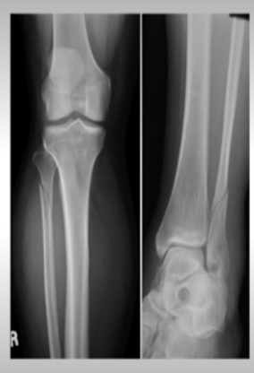 <p>Proximal fibula fracture + tear of medial ligament and syndesmosis (medial malleolus)&nbsp;</p><p>Tx: Long leg splint, NWB, ortho for ORIF</p>