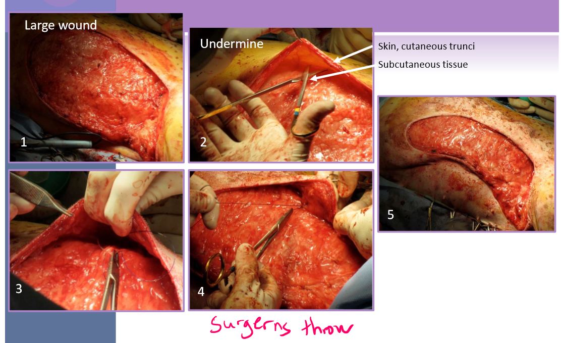 <p>Tension relief - walking sutures </p>