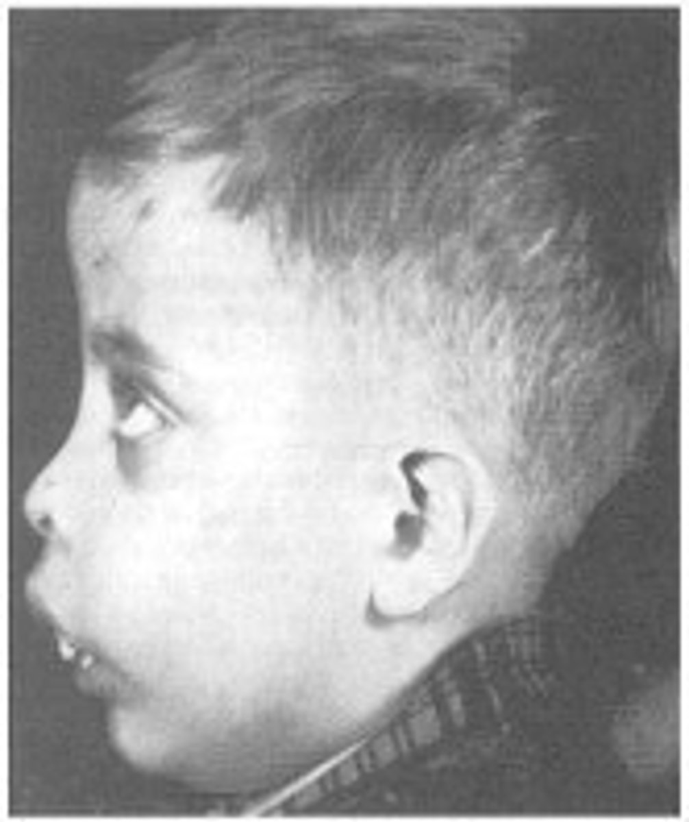 <p>ID the pathology:</p><p>•Hepatosplenomegaly</p><p>•Bone abnormalities</p><p>•Osteopenia</p><p>•Pathological fractures</p><p>•Skin pigmentation</p><p>•Cardiomyopathy</p><p>•Liver fibrosis</p><p>Endocrine failure</p><p>Orofacial features:</p><p>-enlargement of upper jaw, (chipmunk face)</p><p>-migration. and spacing of upper anterior teeth</p><p>increase dental decay</p><p>-delayed dental development</p>