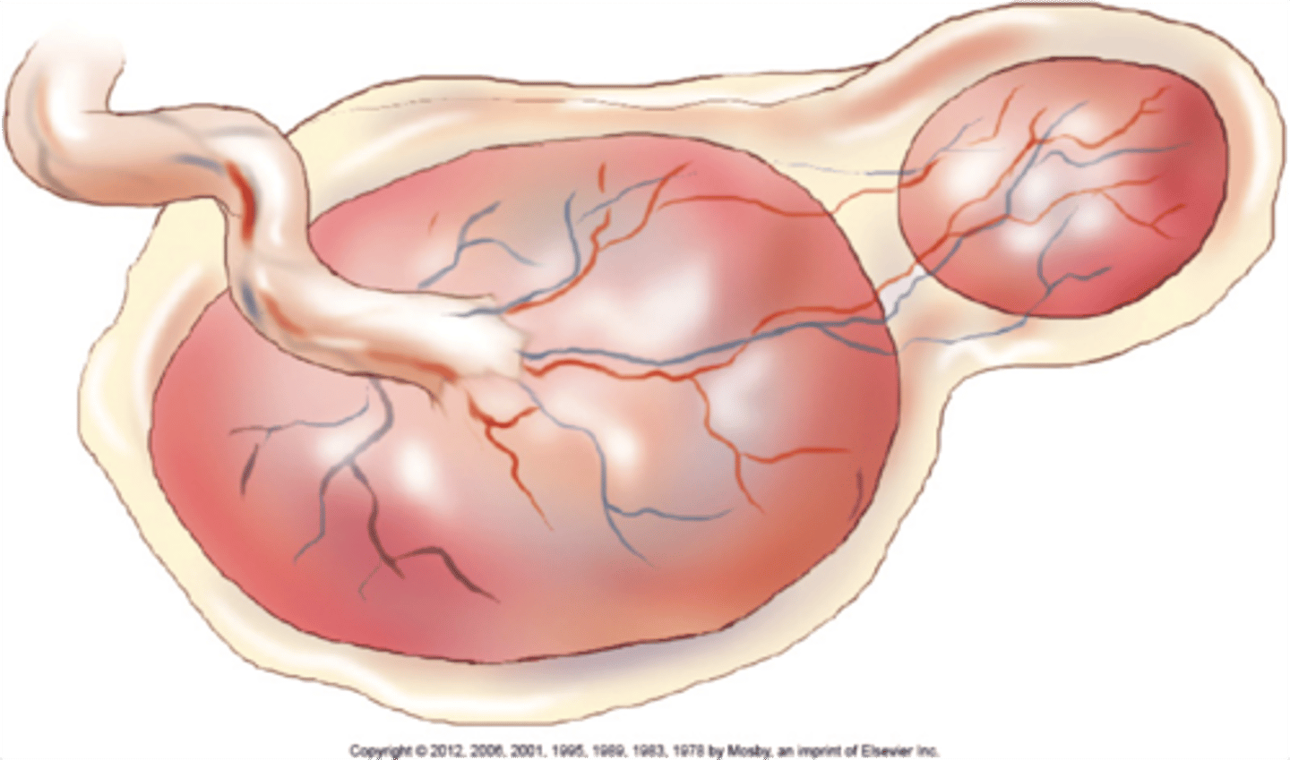 <p>Lobed placenta</p><p>Retained fragments likely</p>