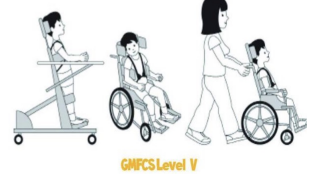 <ul><li><p>level V</p><ul><li><p>patient self mobility will be severely limited, even with the use of assistive technology, requires caregiver</p></li></ul></li></ul><p></p>