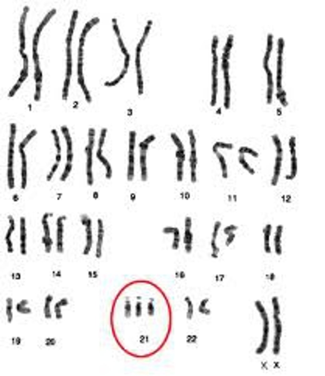 <p>A condition in which an extra copy of a chromosome is present in the cell nuclei, causing developmental abnormalities.</p>