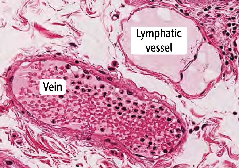 <p>Lymphatic collecting vessels </p><ul><li><p>contain a layer of smooth muscle (akin to the tunica media) that helps propel lymph back to the heart. </p></li><li><p>can be distinguished from veins by a thinner wall and smaller lumen</p></li><li><p>has one-way valves to maintain unidirectional lymphatic flow toward the heart. </p></li><li><p>They join as they rise through the body, forming lymphatic ducts, such as the right lymphatic duct and the thoracic duct.</p></li></ul><p></p>