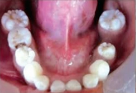 <p>condition associated with these abnormal teeth </p>