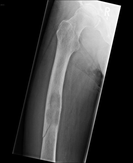 <p>Occurs in bones already weakened by a pre-existing condition.</p>