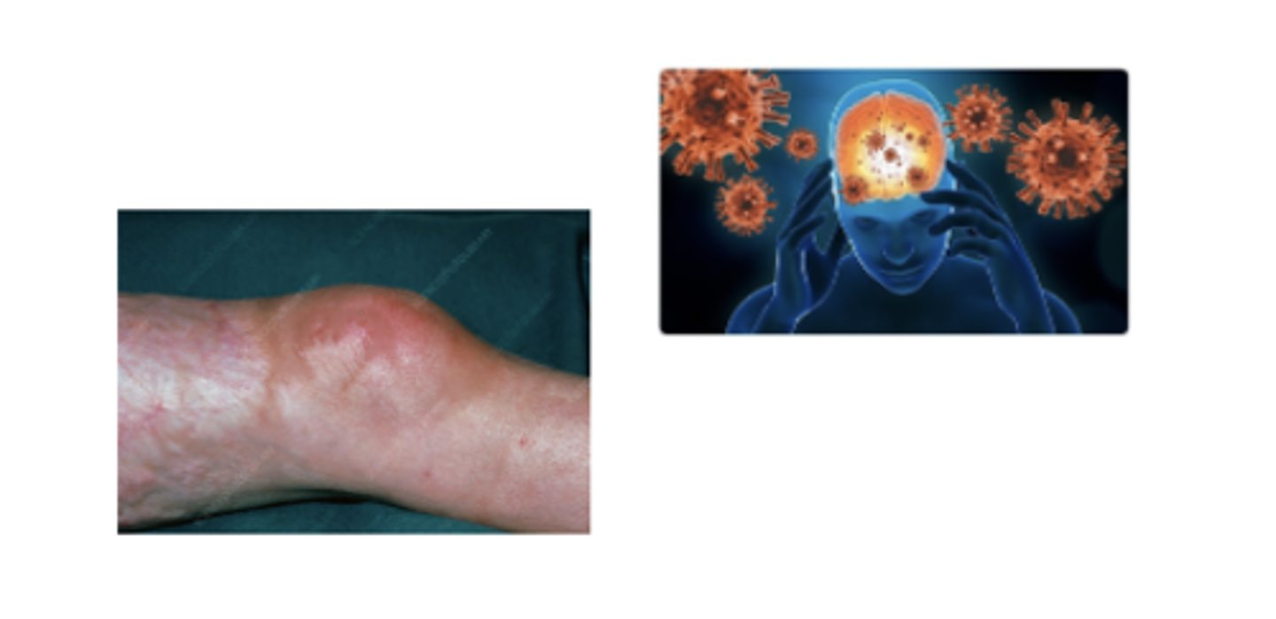 <p>what stage of lymes disease is this</p>