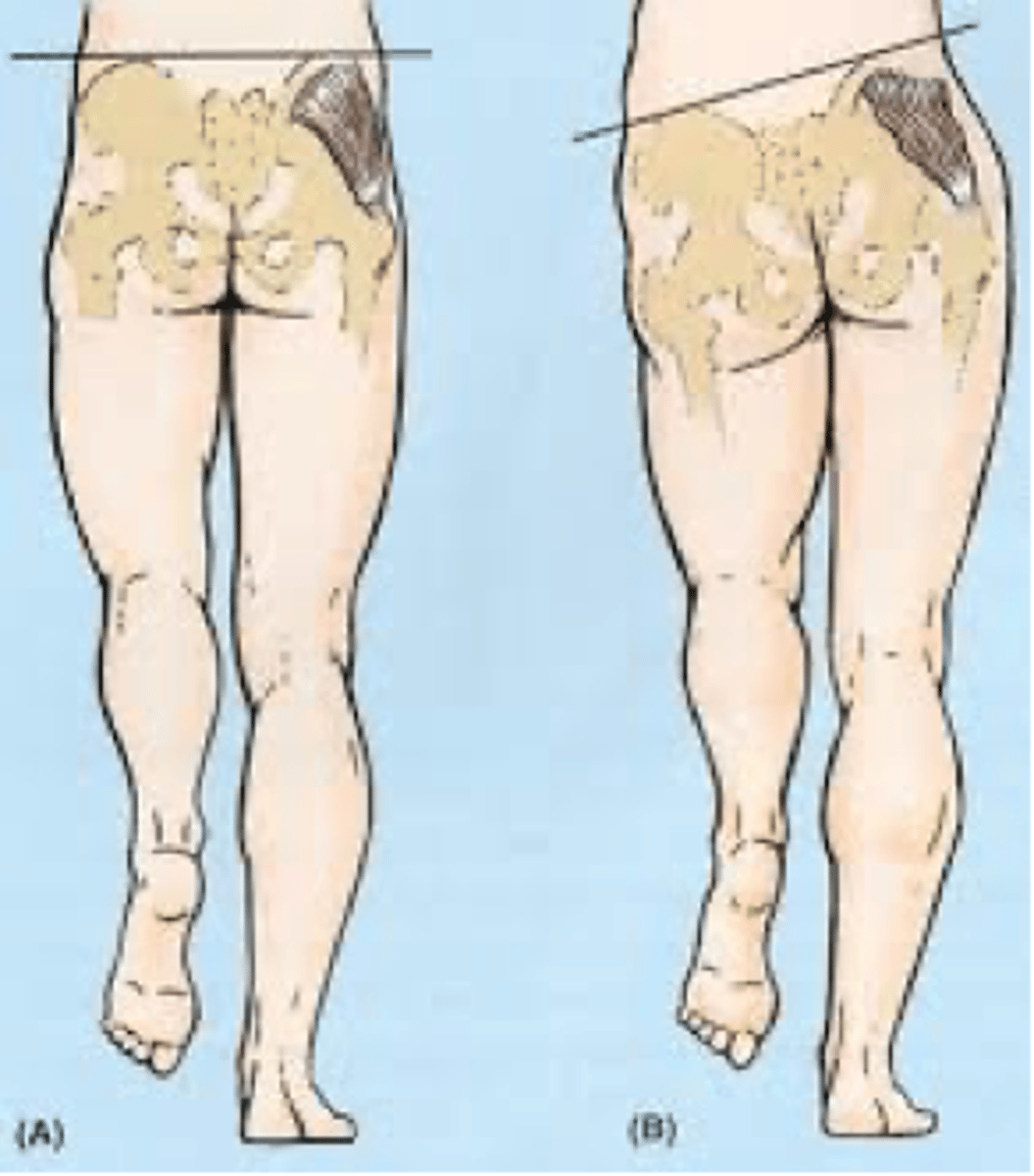 <p>- swinging hip sags low during gait, suggesting problems with the contralateral gluteal region</p><p>- superior gluteal nerve is normally injured in a positive test</p><p>- weakness of gluteus medius/minimus,</p><p>- pelvis drops on the contralateral side of the stance leg</p><p>- loss of abduction of the hip</p>