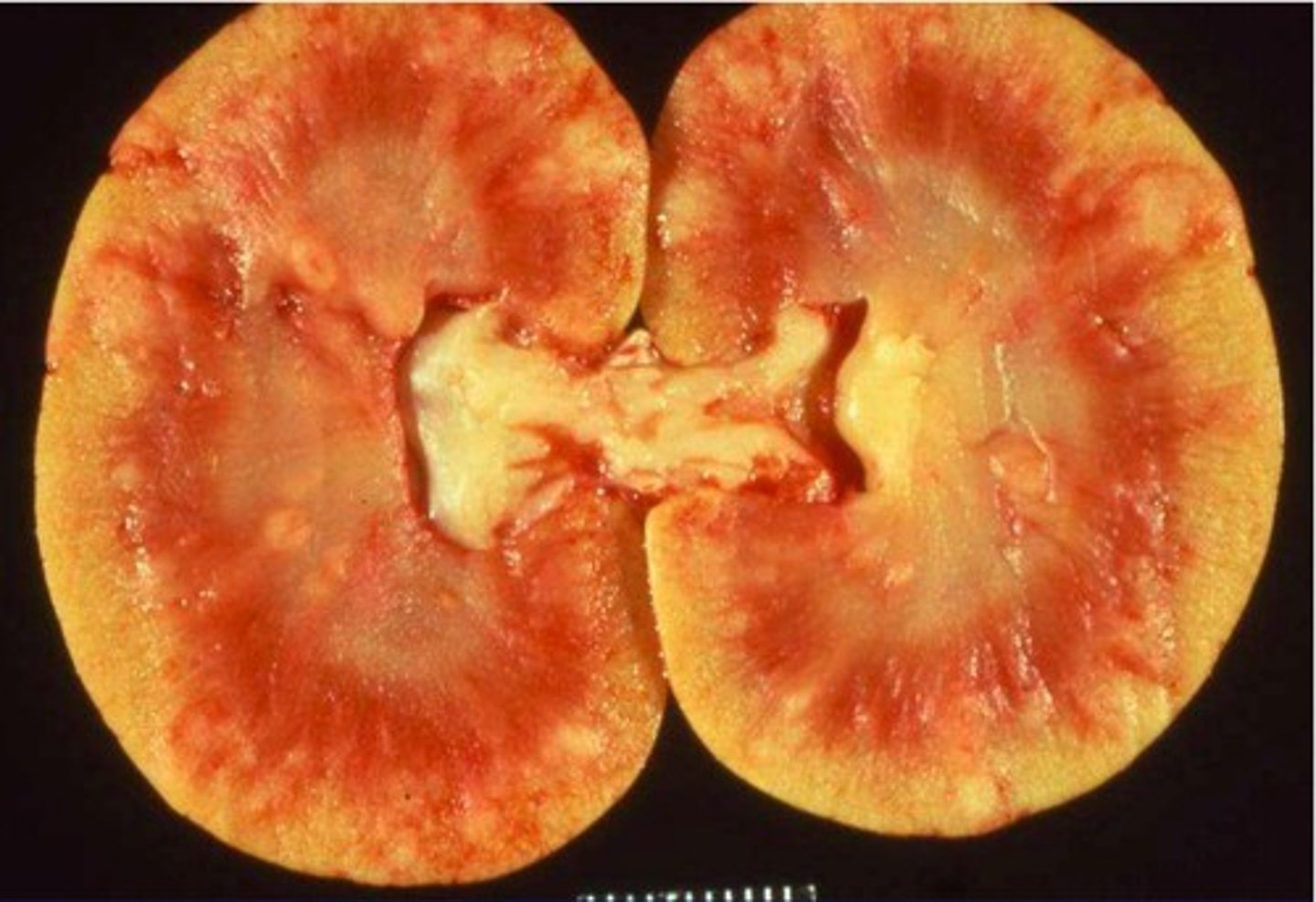 <p>inflammation of a kidney</p>