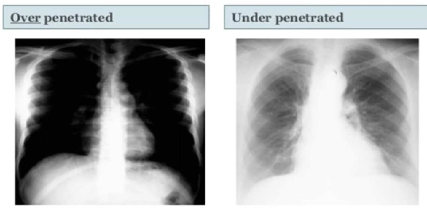 <p>(evaluating AP CXR) exposure</p>