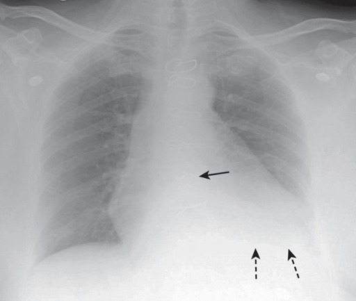 <p>Underpenetration</p>