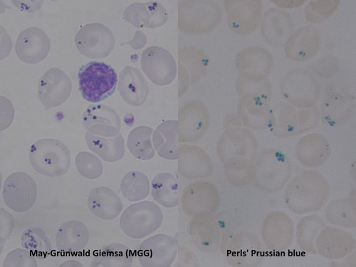<p>D: siderocyte</p><p>reference: CLS review book</p>
